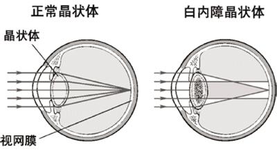 白内障为何会影响视力