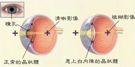 浅谈白内障的临床表现