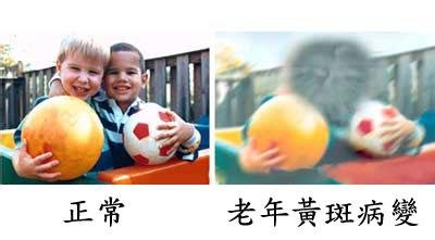 老年黄斑变性如何预防