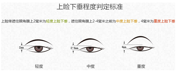 先天性上睑下垂的不良影响