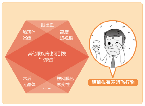 【看图学知识】眼前有黑影该怎么办