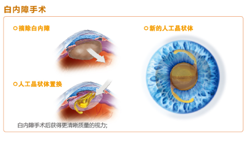【图文解答】如何有效改善白内障