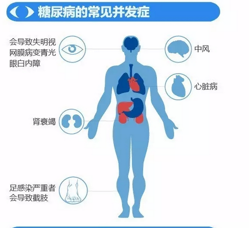 你造吗？糖尿病晚期眼睛会致盲！