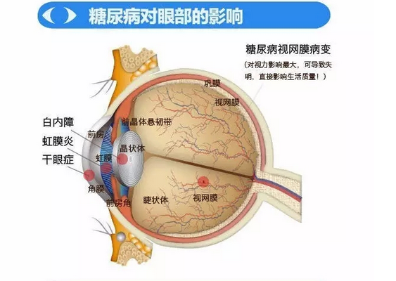 你造吗？糖尿病晚期眼睛会致盲！