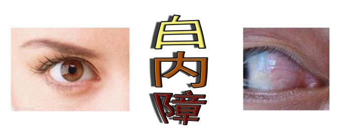 白内障手术会反复吗？
