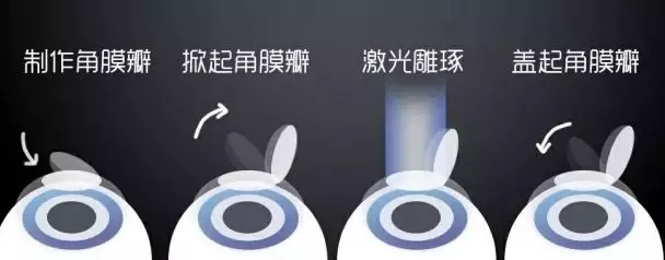 激光近视矫正和ICL晶体植入近视矫正攻略，