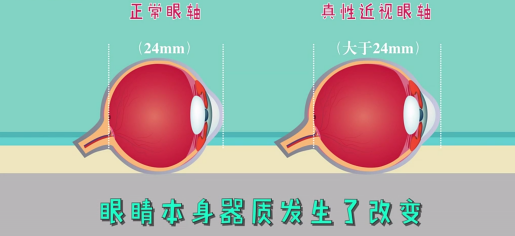 家长该如何辨别孩子的真假性近视?