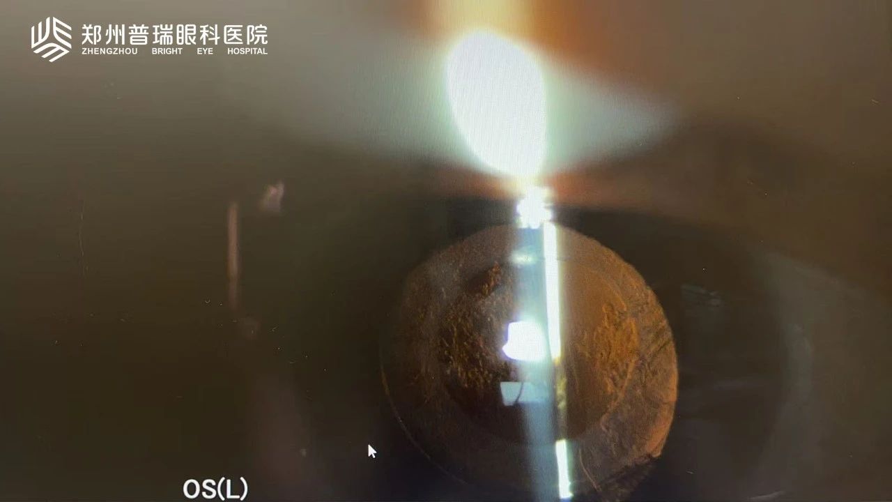 白内障术后视力又下降？6大原因多方面解析！