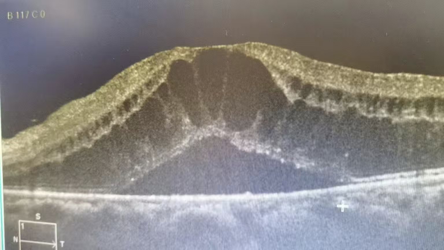 视力骤降、视物变形，警惕黄斑水肿偷走中心视力！